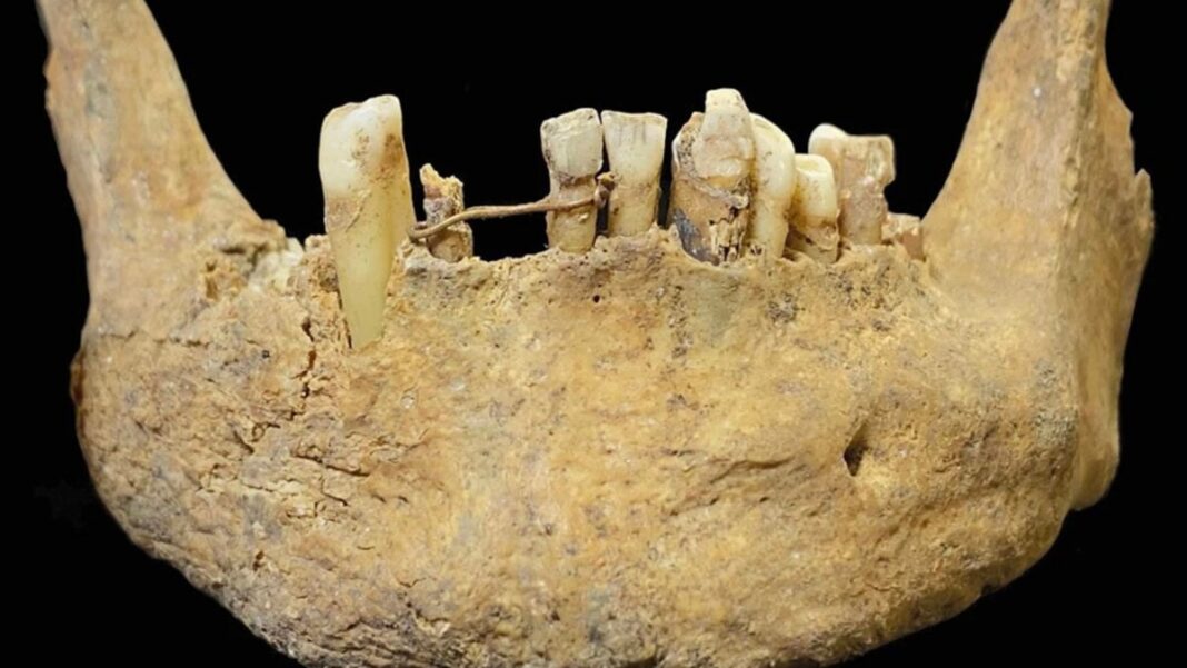 Archaeologists Unearth ‘Advanced’ Gold Dental Bridge in Medieval Scottish Grave